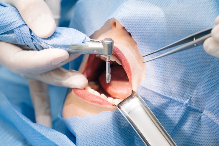 Clínica odontológica é condenada a pagar indenização após implante dentário mal sucedido